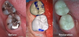Damaged teeth before and after CEREC Crowns