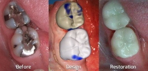 Damaged teeth before and after CEREC Crowns Damaged teeth before and after CEREC Crowns